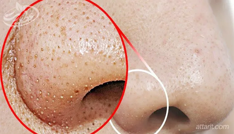 بخور آویشن برای رفع جوش های سر سیاه